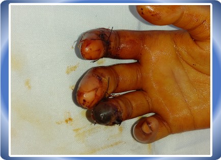 FINGER INJURY